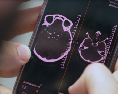 Philips Neuro suite with SmartCT
