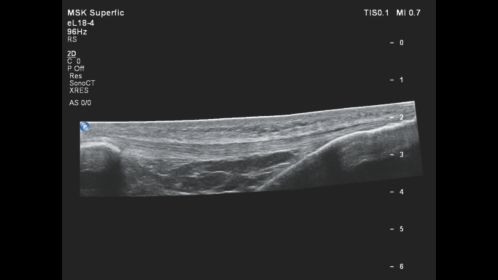 Patellar Tendon in 2D Panoramic View with the eL18-4 transducer