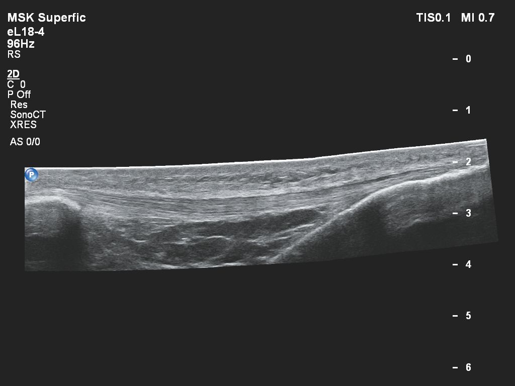 Patellar Tendon in 2D Panoramic View with the eL18-4 transducer