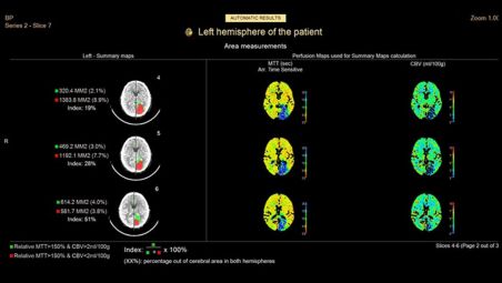 Zero-click automated stroke assessment workflow and result sharing​