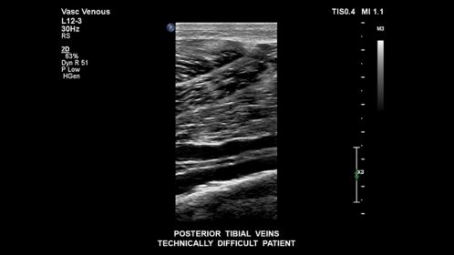 Posterior tibial veins from a technically difficult patient. 