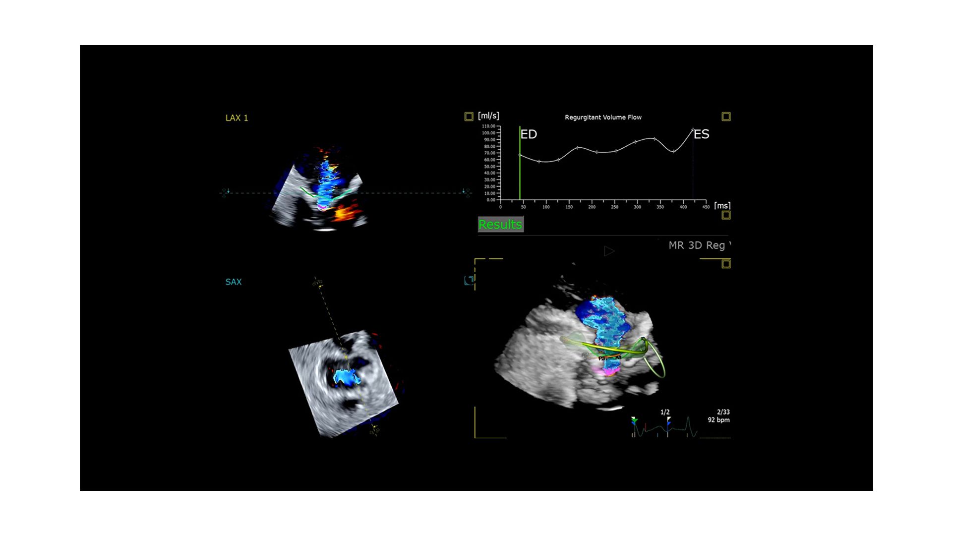 Quantitatively assess mitral valve leakage