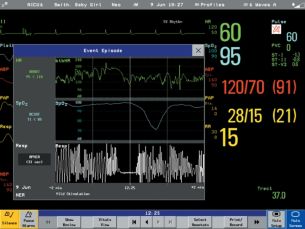 Oxy-CRG Neonatal respiratory monitoring