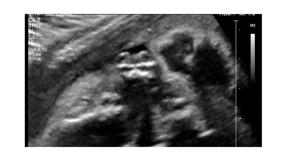 2D transverse view using the C9-2 transducer, measuring the bilateral defects in the alveolar ridge