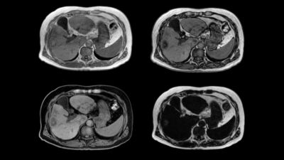 Philips - mDIXON XD FFE - Abdomen MR clinical application - Philips