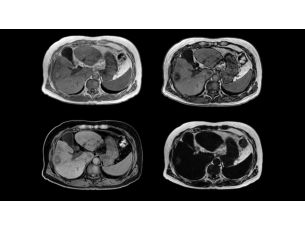 mDIXON XD FFE - Abdomen MR clinical application