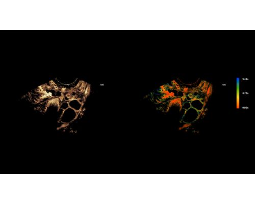 SuperRes MVI & TOA Clinical Image improves resolution