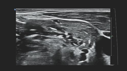 Brachial plexus nerves