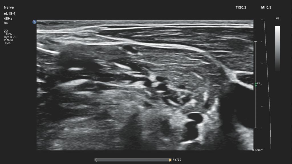 Brachial plexus nerves using eL18-4 transducer on Compact 5000 Series