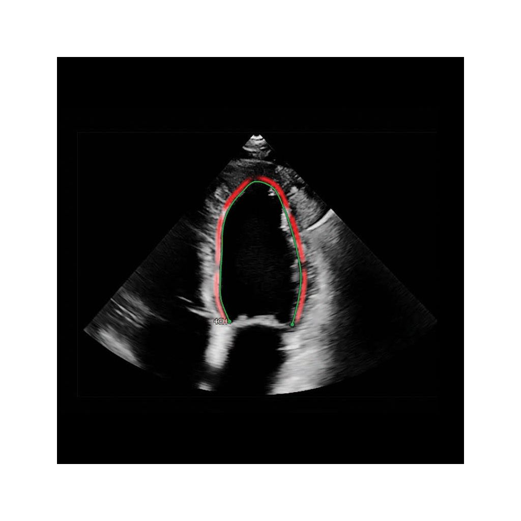 AutoStrain Clinical images showing Auto Contour Placement - LV focused view with Auto Contour Placement