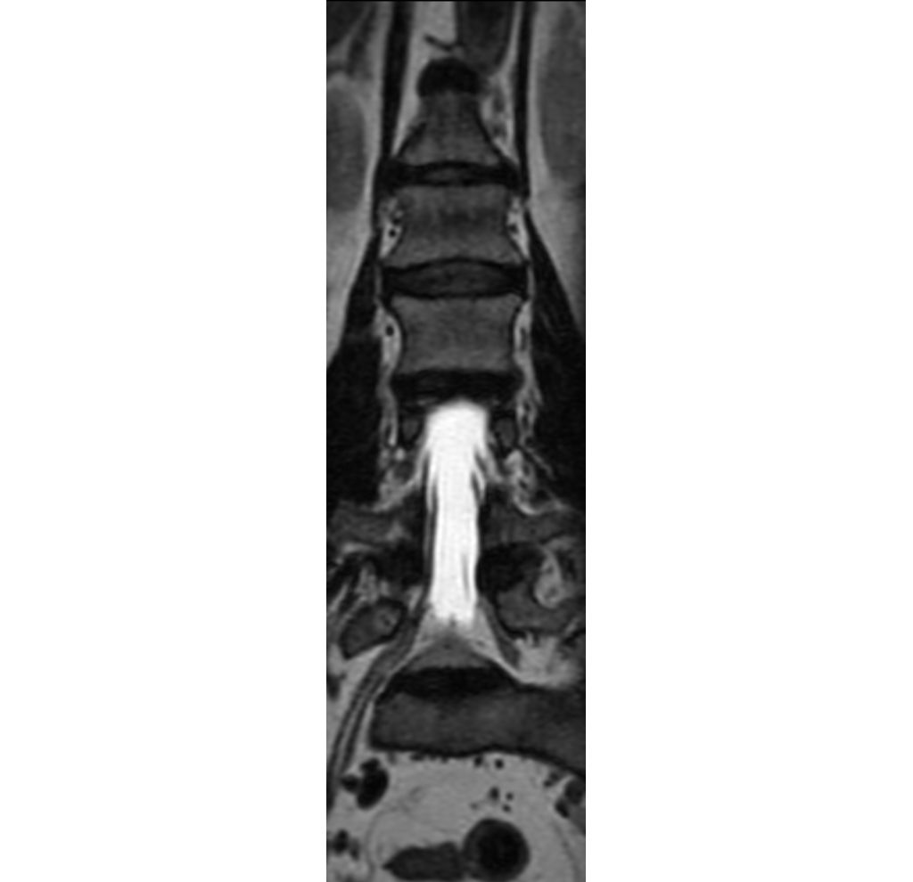 3D SpineVIEW T2w TSE (reformat)