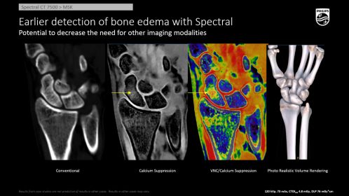CT Spectral 7500 MSK Ca Supp Scaphoid Fx