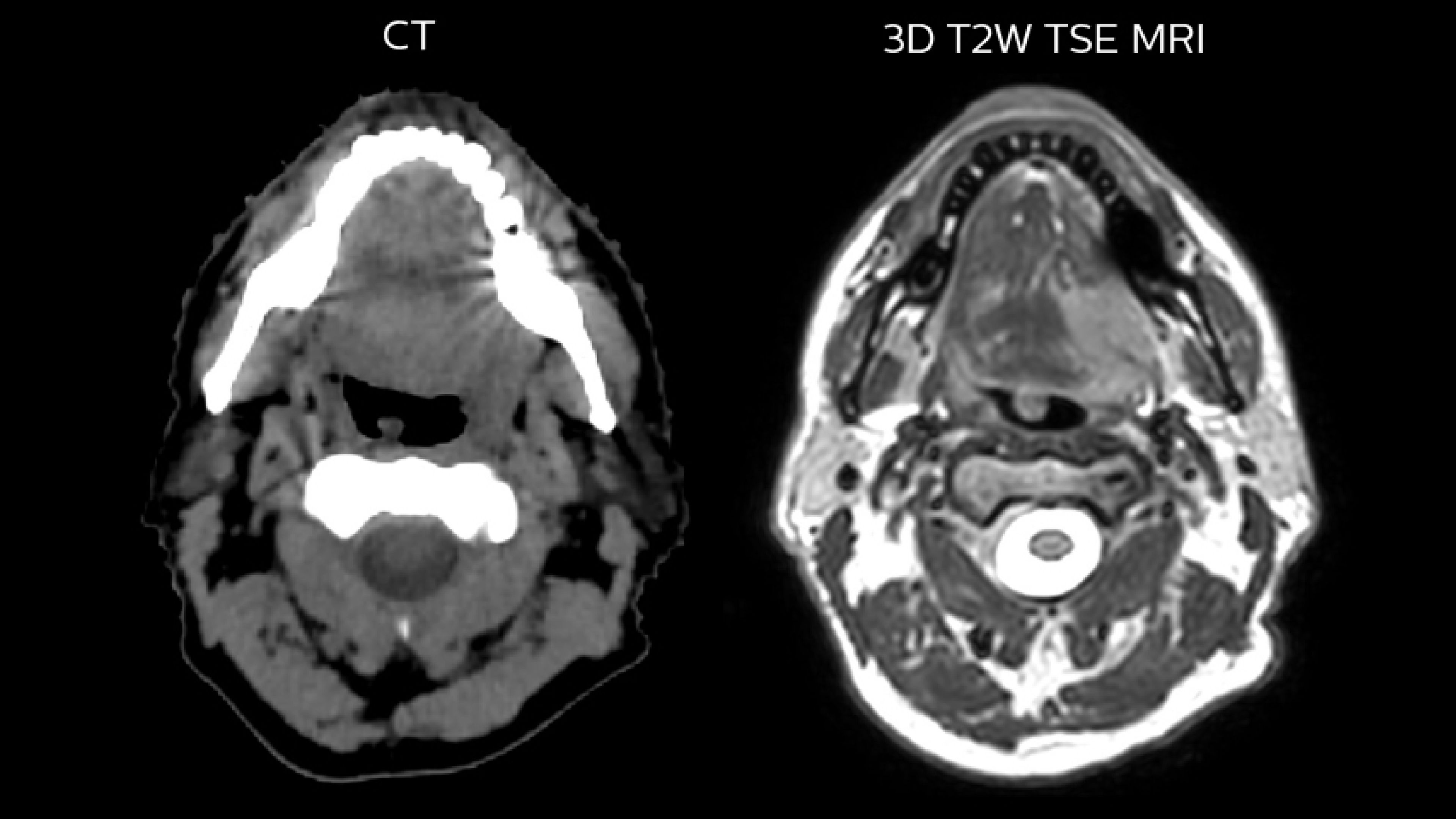 Comparison of CT simulation scan (left) and T2W 3D MRI (right) 