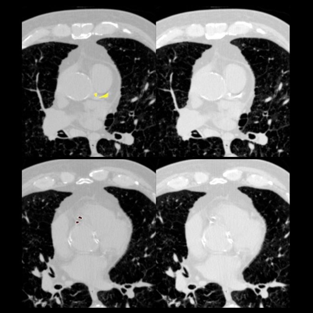 Coronary Artery Calcification Analysis (CAC™)