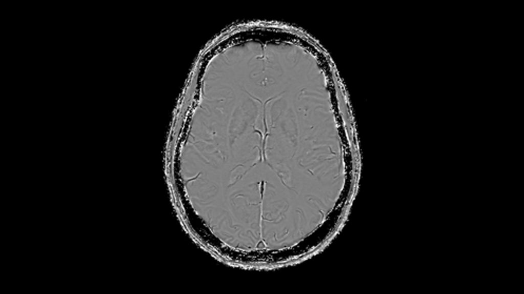 3D SWI (Phase) clinical image of the brain