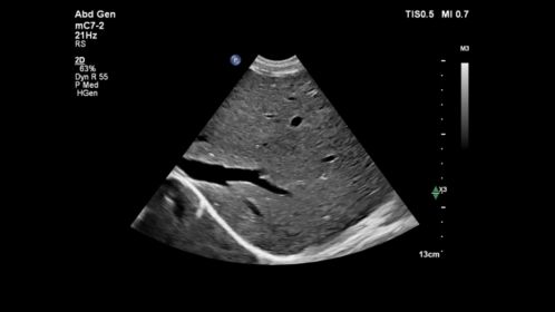mC7-2 Abdominal Liver