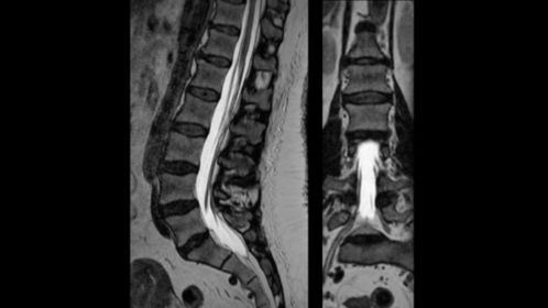 3D T2w TSE SpineVIEW