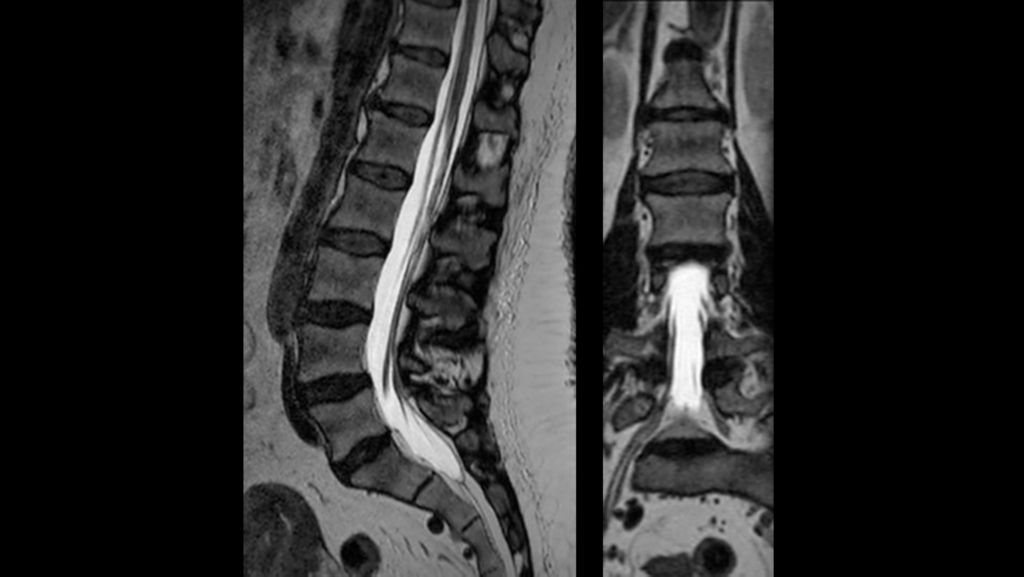 3D T2w TSE SpineVIEW