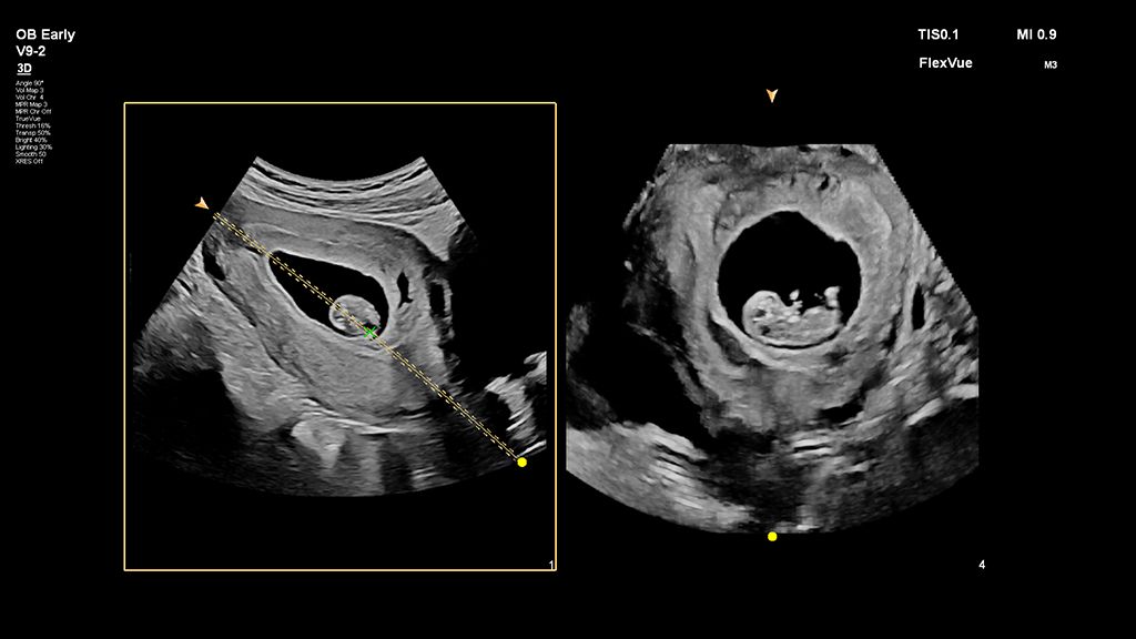First trimester fetal image using FlexVue