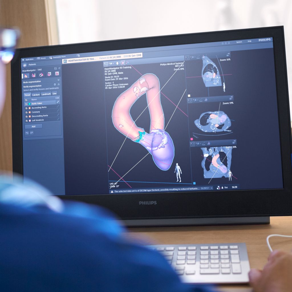 Heartnavigator Philips