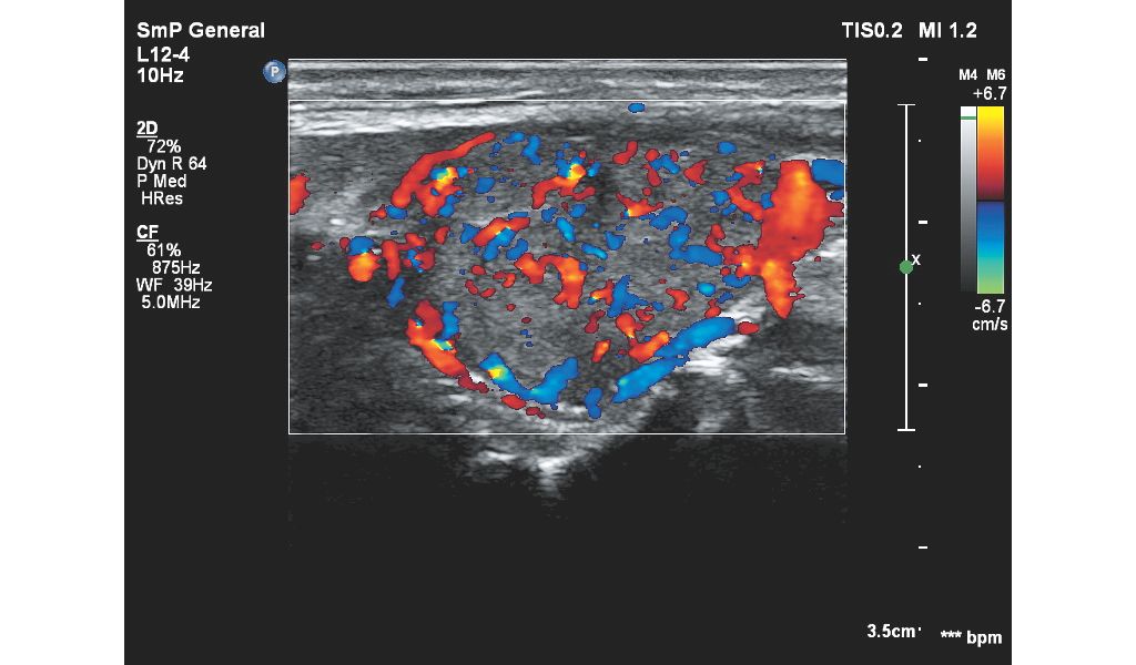 Affiniti 30 ultrasound clinical image 