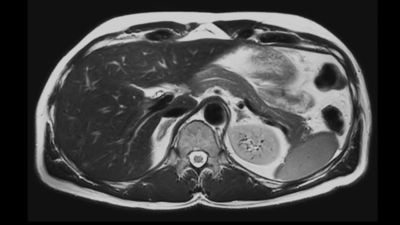 Philips - MultiVane XD - 腹部 MRクリニカルアプリケーション