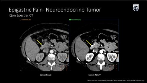 IQon Spectral Epigastric Pain