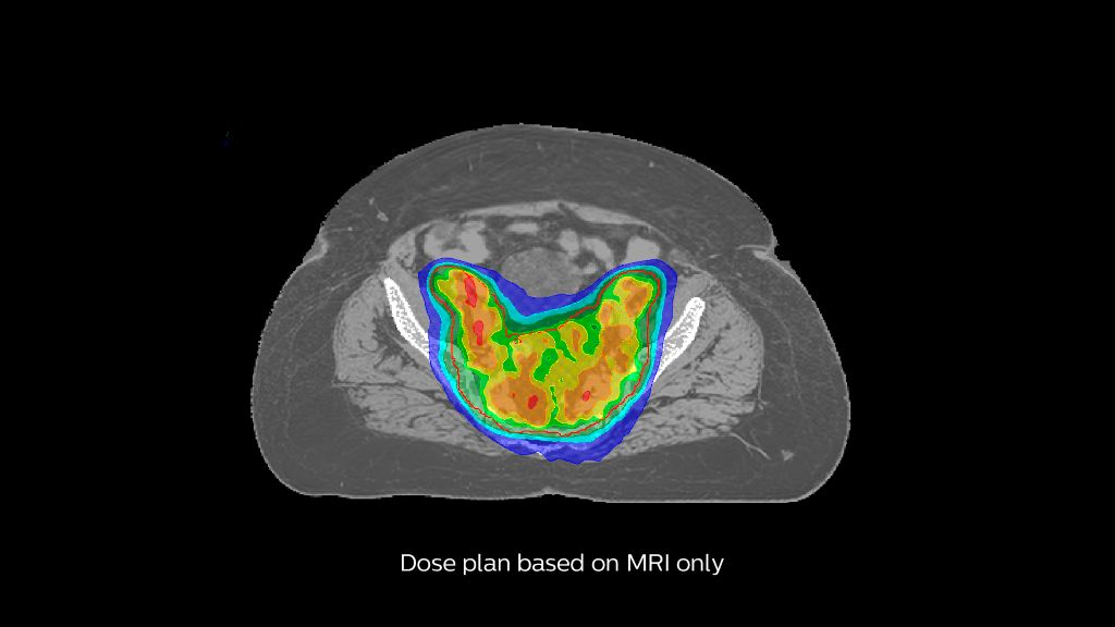 Automatic generation of synthetic CT images
