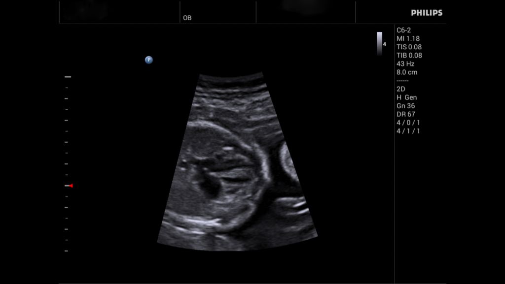 C6-2 Fetal Echo
