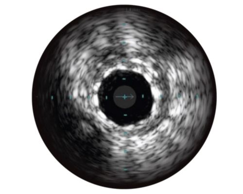 Assessment of stent expansion
