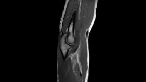 

Elbow PDw TSE

