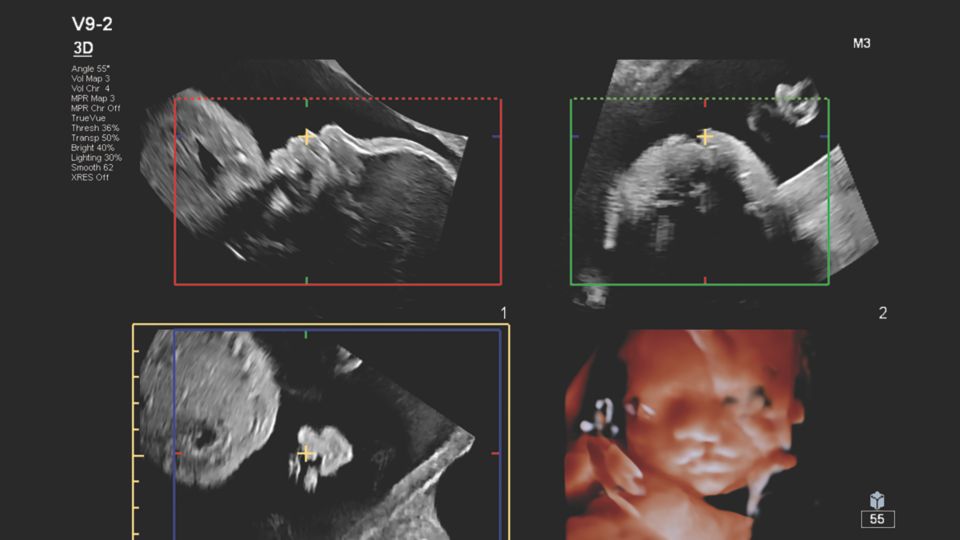 Figure 3 V9-2 transducer 3D volume and MPR images of unilateral cleft lip