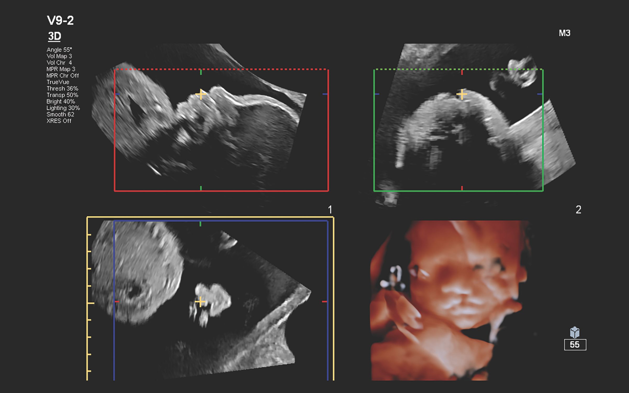 Figure 3 V9-2 transducer 3D volume and MPR images of unilateral cleft lip