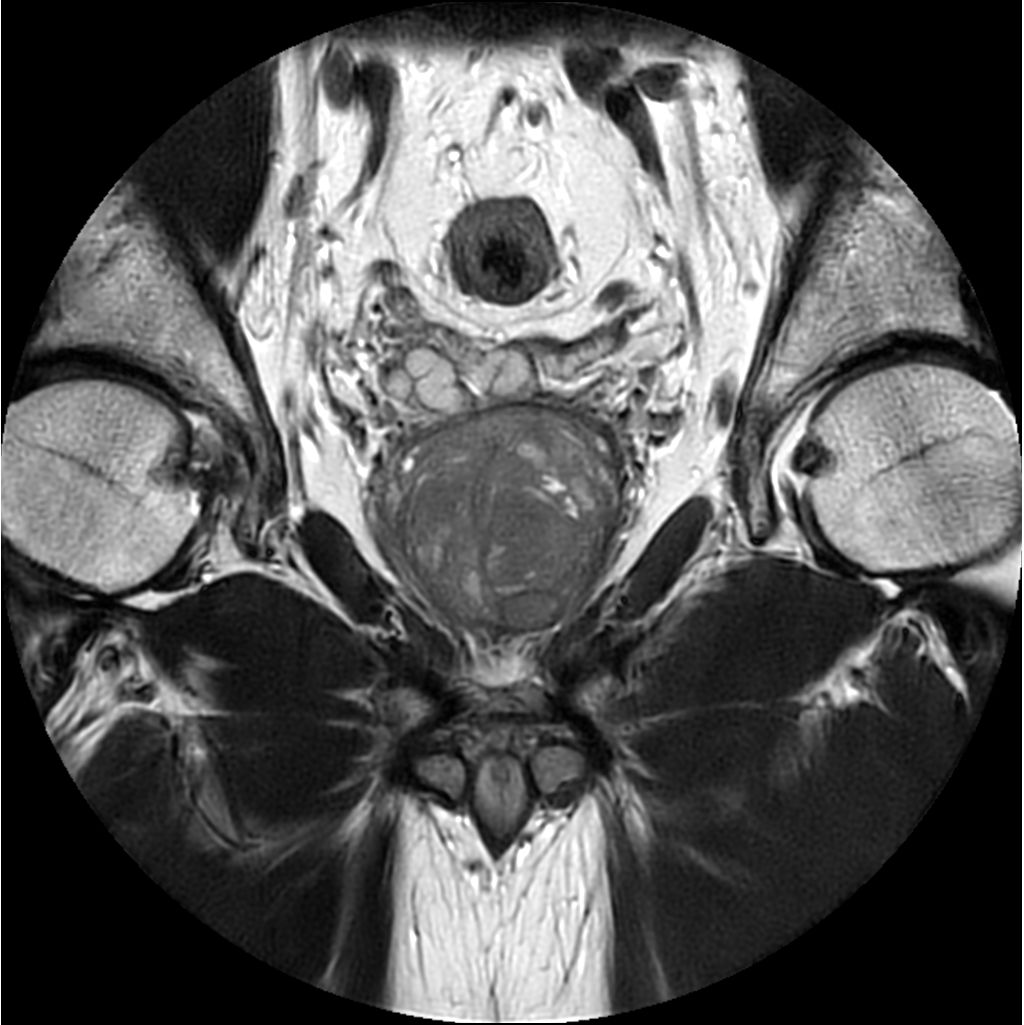 MultiVane XD - Coronal T2w TSE