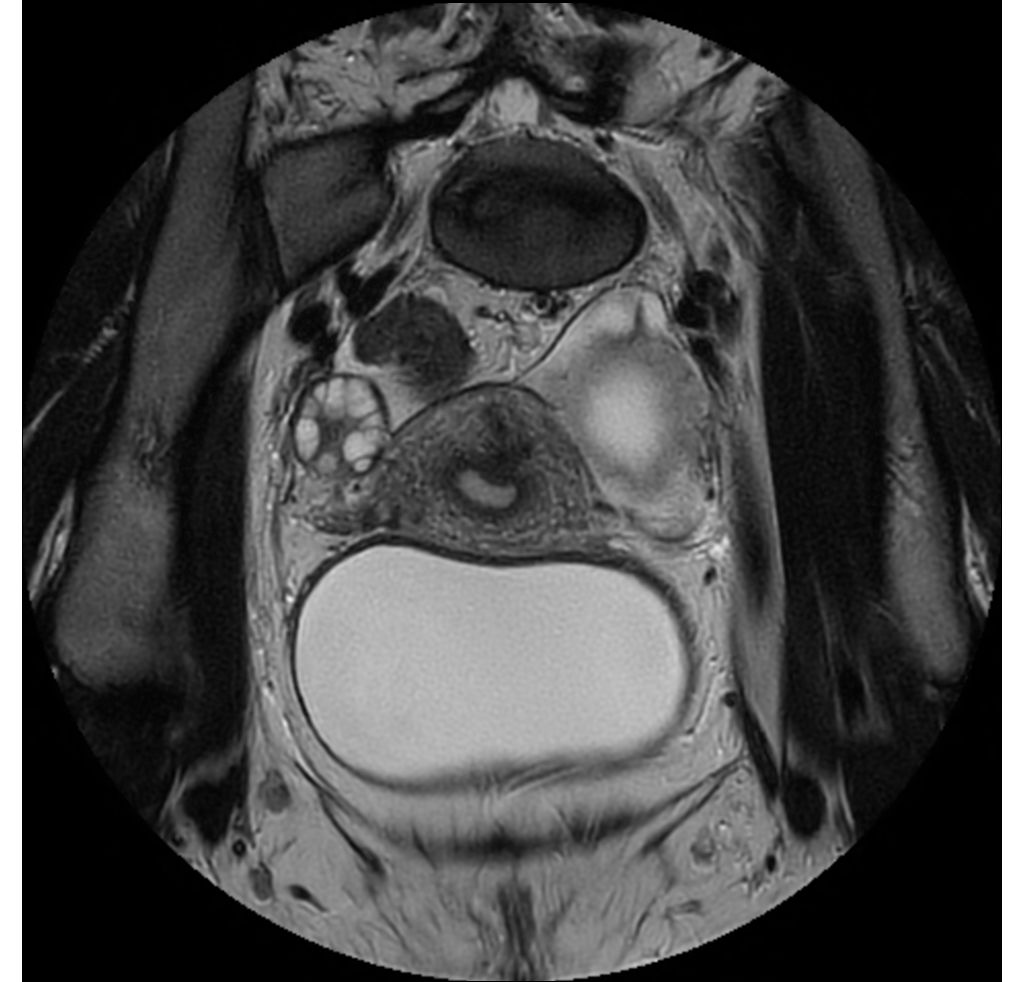 MultiVane XD - Coronal T2w TSE