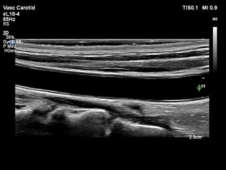 eL18-4 Vascular Carotid