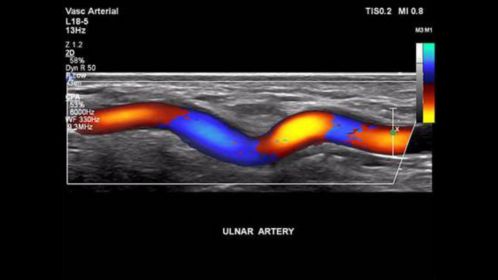 EPIQ ultrasound machine clinical image 