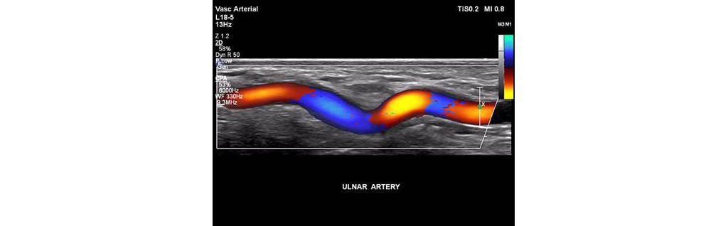 EPIQ ultrasound machine clinical image 