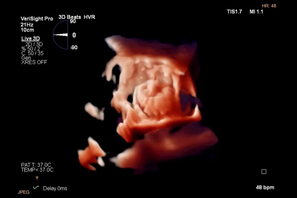 LAAO view via TrueVue 3D rendering and MPRs: 3D imaging mode - Image courtesy: Dr. Andrea Natale, St. David’s Medical Center