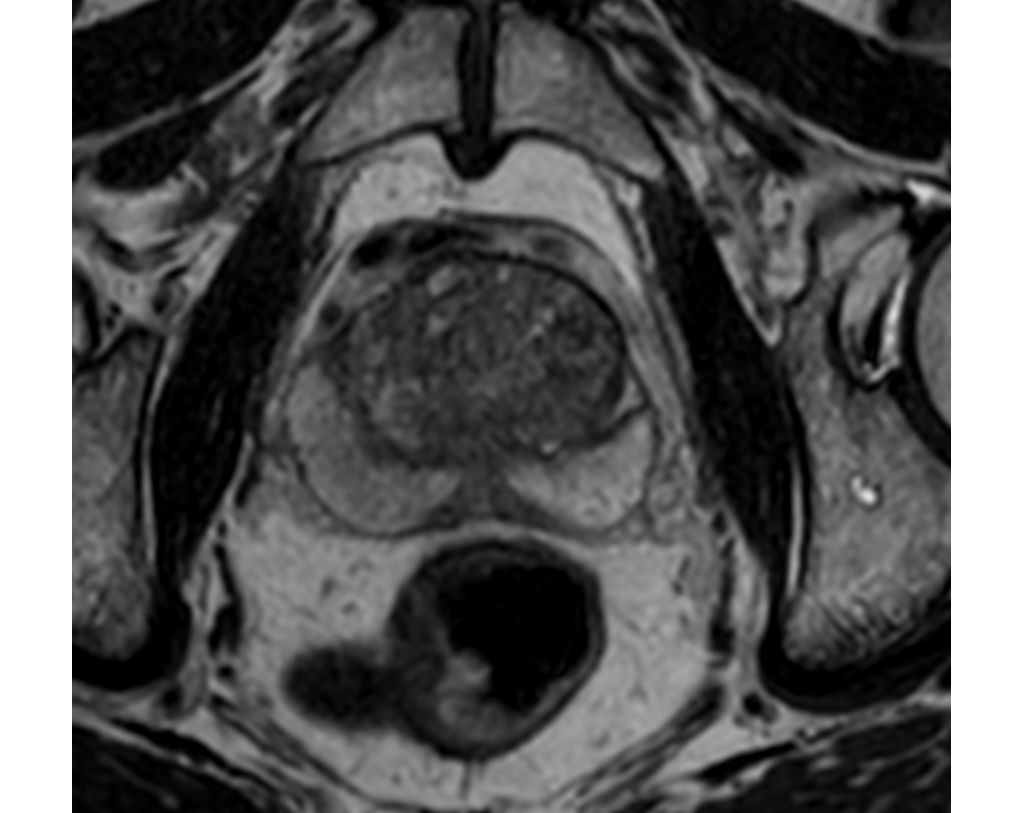 3D PelvisVIEW - Axial T2w TSE