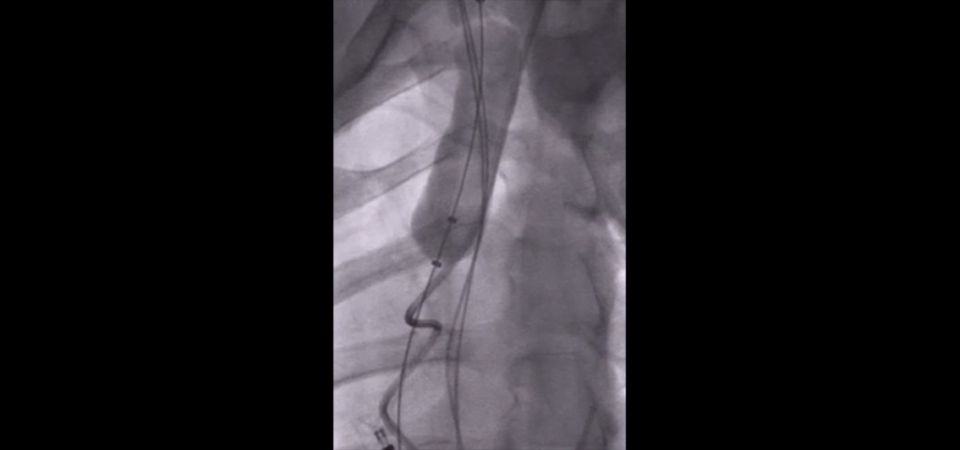 Bridge occlusion balloon