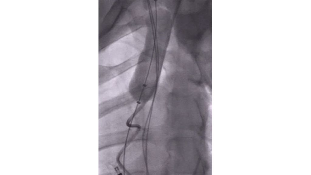 Bridge occlusion balloon
