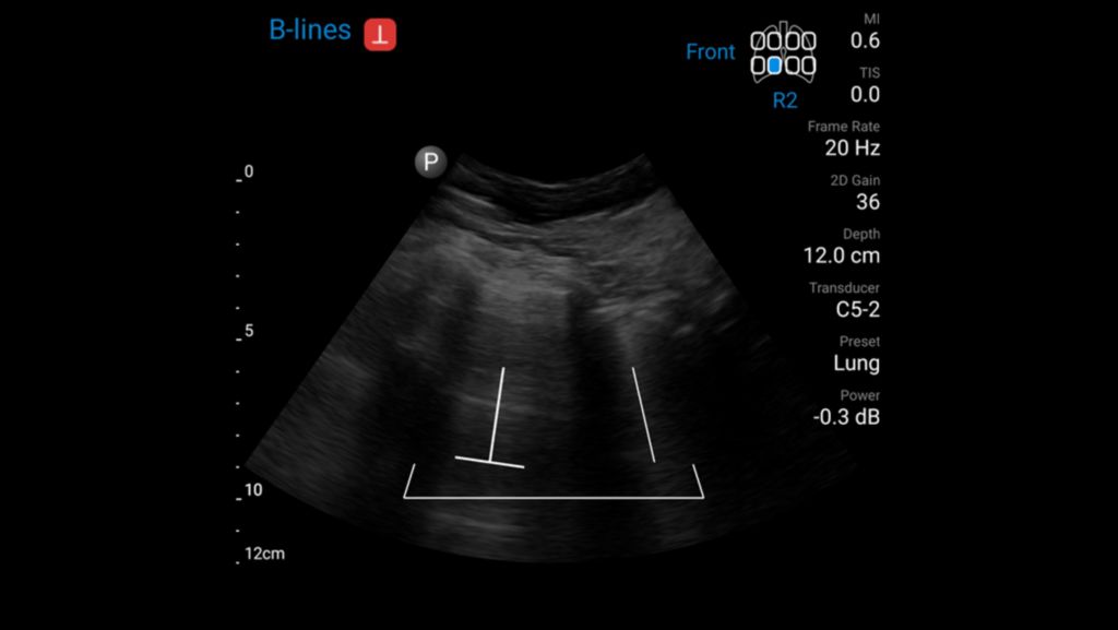 Lung ultrasound demonstrating auto B-Lines feature using C5-2 transducer.