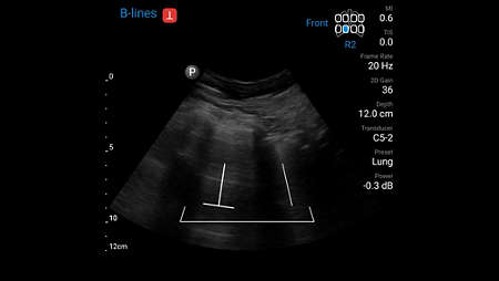 Lung ultrasound demonstrating auto B-Lines feature using C5-2 transducer.