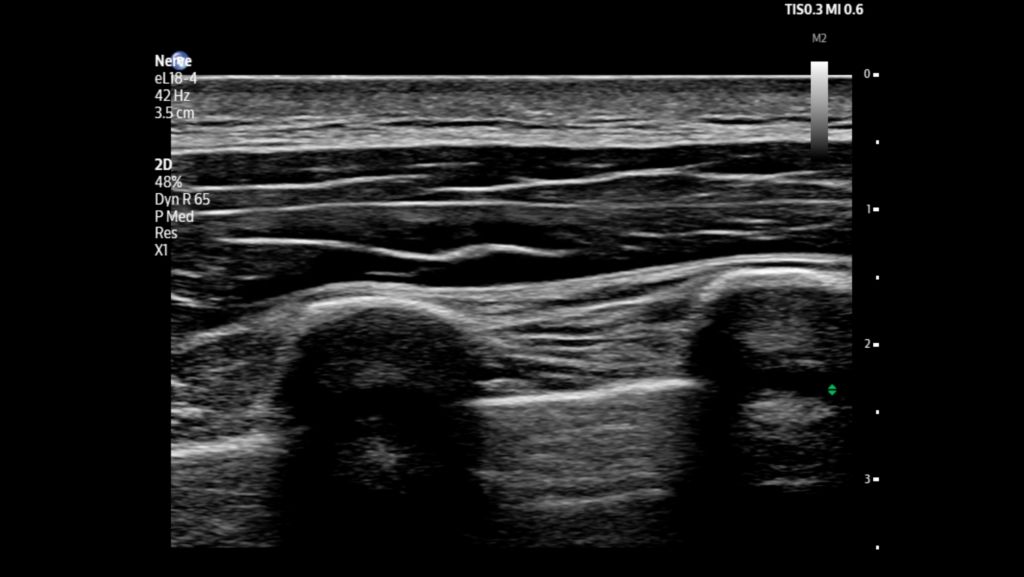 Thoracic paravertebral using eL18-4 transducer.