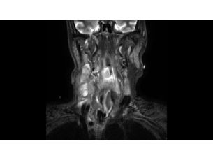 Compressed SENSE Klinische MR-Applikationen