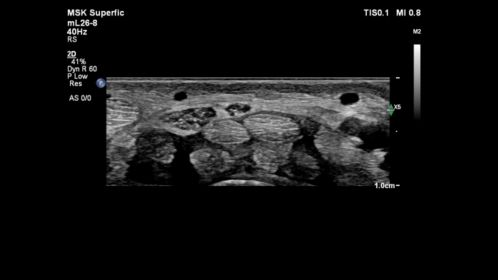 mL26-8 MSK Wrist