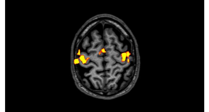 BOLD MR Clinical application | Philips