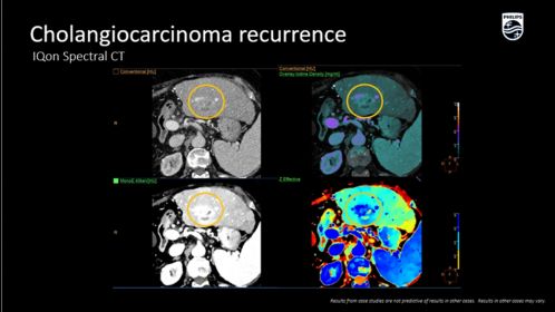 IQon Spectral Cholangiocarcinoma recurrence
