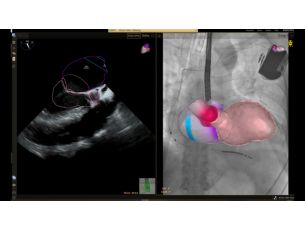 EchoNavigator Live echo and live X-ray fusion tool